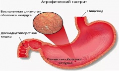 Атрофический гастрит - причины, симптомы, лечение и профилактика